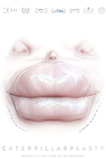 Papillioplastie (Papillioplastie)