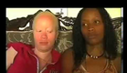 Oscar winner Lupita Nyong'o "In My Genes" Documentary on Albinism Trailer