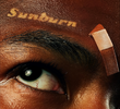 Sunburn