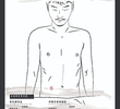 Stoma