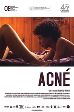 Acne (Acné)