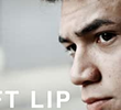 Cleft Lip