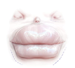Papillioplastie